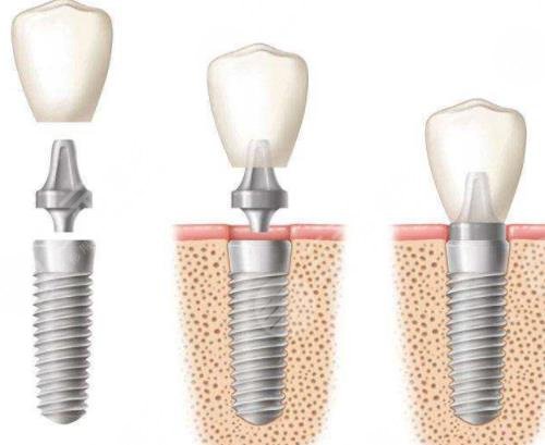 种植牙示意图