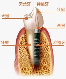 种植牙