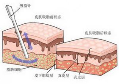 溶脂的作用与功效