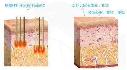 做热玛吉多少钱一次?