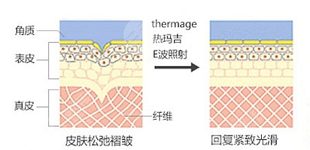 做完热玛吉多长时间有明显的效果?原理、费用盘点~