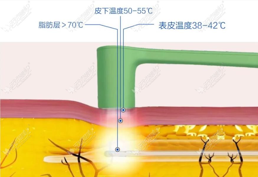 福州大腿抽脂价格一览表,内含福州海峡大腿吸脂的收费明细