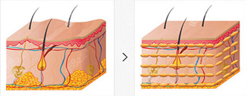 脂肪填充皮肤前后变化