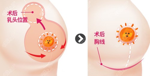 韩国id医院做缩胸手术