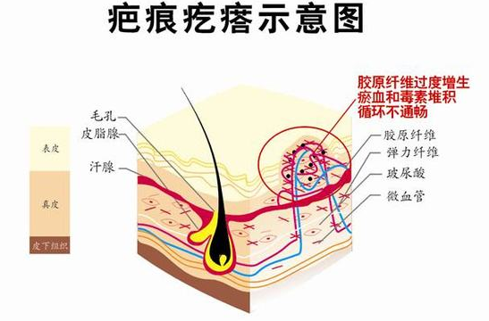 怎么确定自己是不是疤痕体质呢？