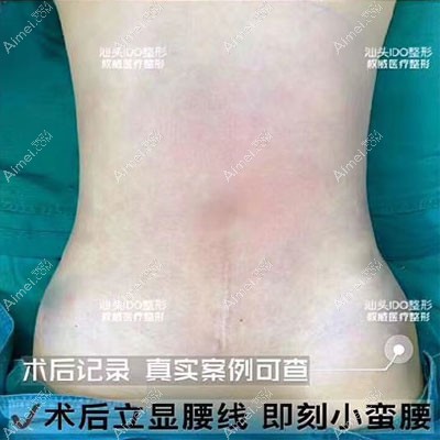 在汕头做360水动力腰腹环吸经历：术后疼了3天腰围瘦了10cm