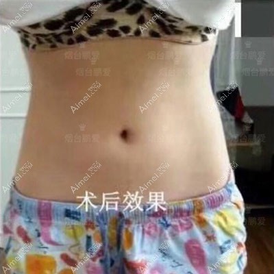 腰腹环吸3个月复盘：抽脂1300ml小肚子平坦瘦4cm,烟台鹏爱靠谱