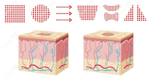点阵激光祛痘印痘坑原理
