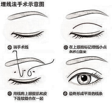 双眼皮手术方式大解析