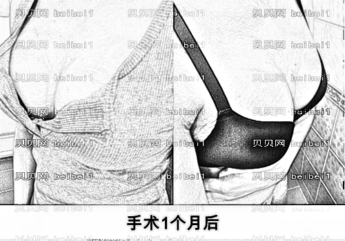 西安高一生医疗美容医院张林宏自体脂肪移植丰胸介绍