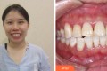 成都拉斐尔口腔诊所王雪梅整形价格表附牙齿矫正案例果