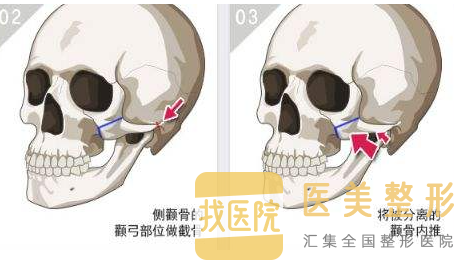 颧骨磨骨