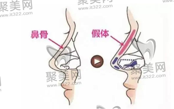 隆鼻假体取出注意事项有哪些