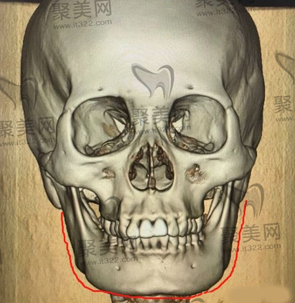 做完下颌角手术感觉没变化