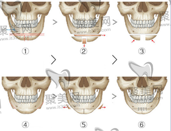 北京圣嘉新下颌角截骨手术过程