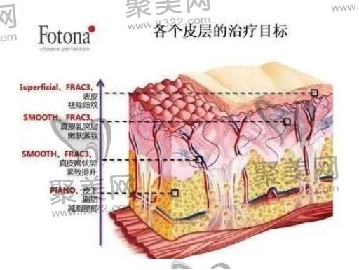 欧洲之星fotona4d抗衰多久做一次?