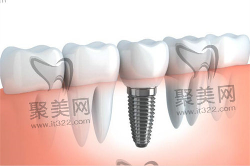 种植牙