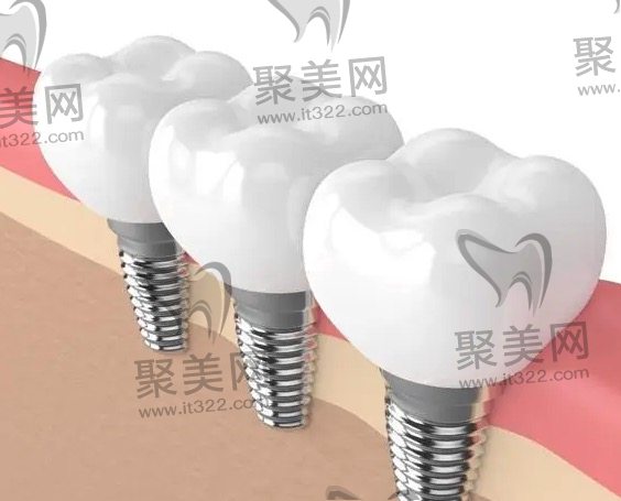 正规医院种植牙费用明细