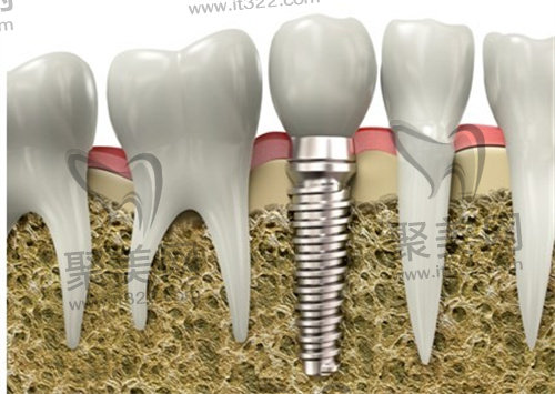 种植牙