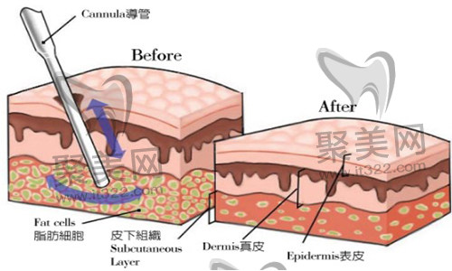 腰腹吸脂