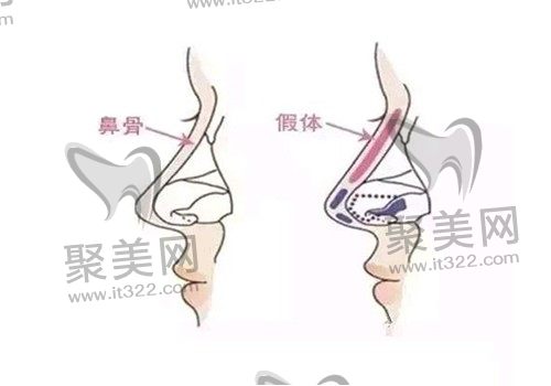 隆鼻想长久建议硅胶还是膨体，特色优势和价格全面分析！