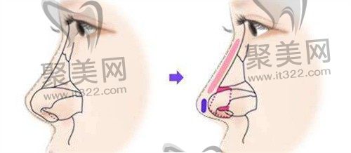 肋骨鼻和耳软骨隆鼻的区别是啥？听说肋骨鼻做完后悔死了真的吗