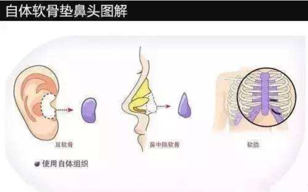 自体软骨隆鼻与假体隆鼻的区别有哪些方面？