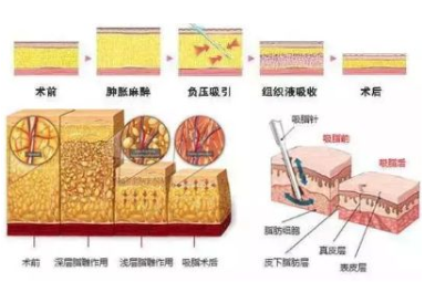 吸脂会让皮肤松弛吗？