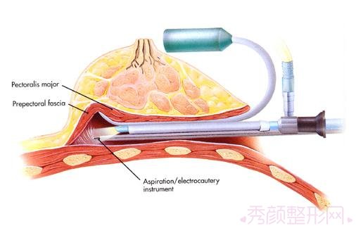 北京八大处栾杰内窥镜隆胸怎么样？有案例吗？