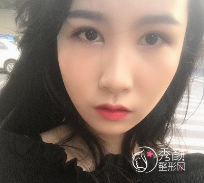 上海华美杨亚益割双眼皮开眼角恢复过程，7mm扇形真的很适合我！