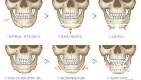 动辄十几万到数十万的正颌手术到底该不该做？