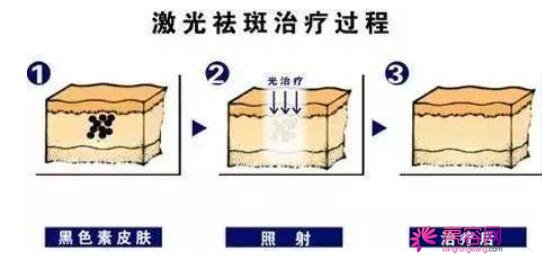 祛斑较有的8个偏方分享！长斑都有那些因素呢？激光祛斑案例