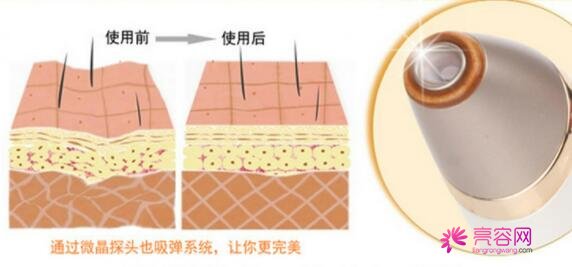 微晶磨皮术会留疤吗？微晶磨皮术是什么原理呢？有什么注意事项吗？