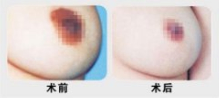 咱们来聊聊乳晕整形需要多少钱 乳晕整形术会有