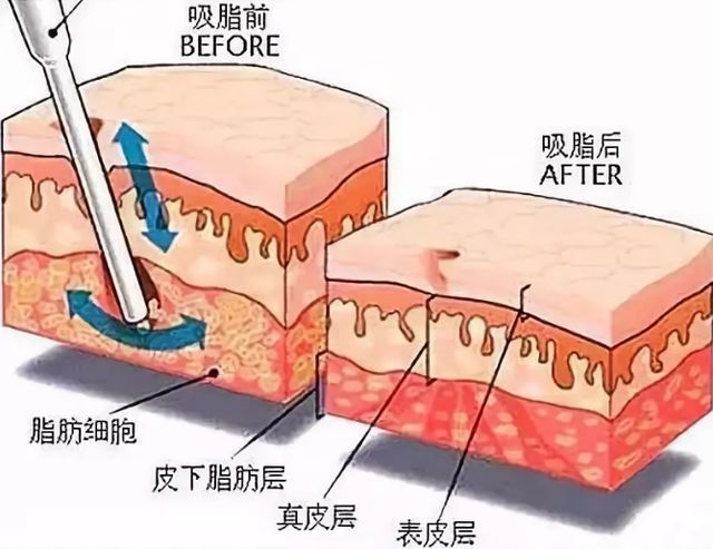 科学、健康、轻松的减肥方法，吸脂了解一下！