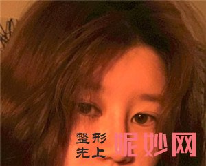 在北京圣嘉荣医疗美容医院做的鼻部多项怎么样？真人案例术前术后对比图分享！