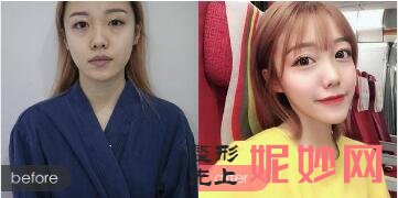 太原美之妍医院整形技术怎么样?坑人不?美之妍曹立铭双眼皮案例效果及价格