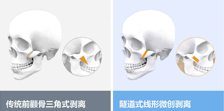 北京圣嘉新张立天：做完颧骨内推需要花很多钱维护吗?