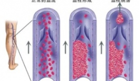 疫情期间家中宅，当心血栓找上门