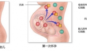 抗-D与Rh相关新生儿溶血病的故事