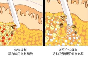 吸脂示意图