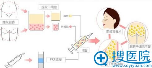 自体脂肪填充流程