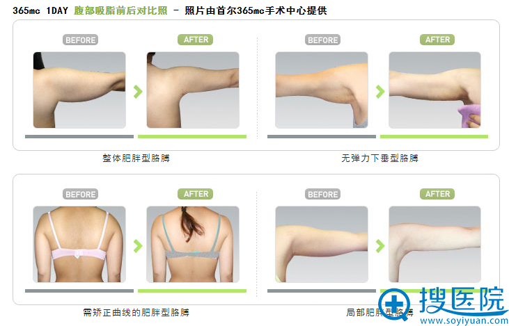 韩国首尔365mc医院胳膊吸脂前后对比案例