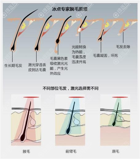 激光脱毛原理