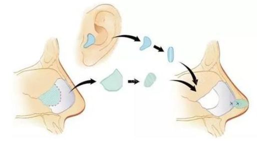 耳软骨隆鼻示意图