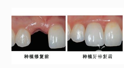 种植牙要如何保养寿命更长