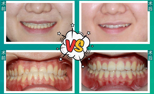 深圳登特口腔医院地包天正畸案例