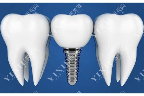 种植牙和真牙对比模型示意图