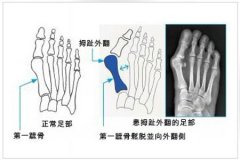 什么原因导致拇外翻呢