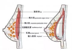 假体隆胸影响喂奶吗